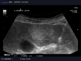 Ultrazvok trebuha - Večji hemangiom jeter